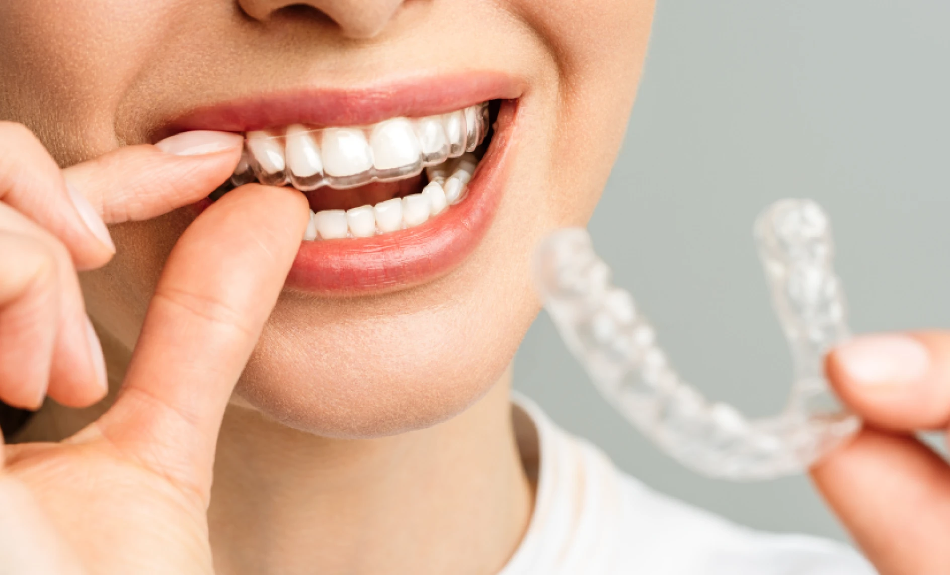 Contention orthodontiste Lille